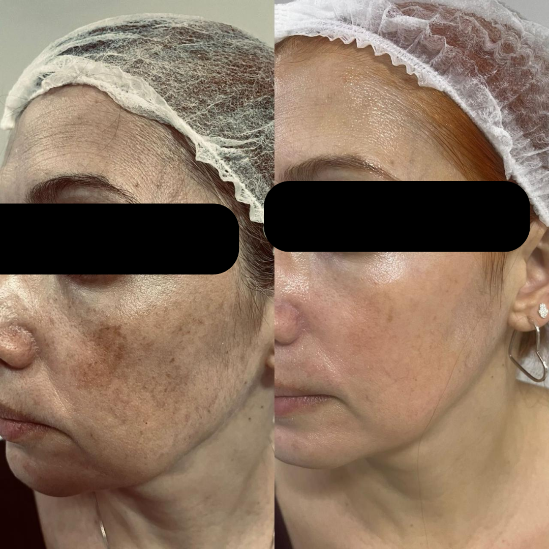 Resultado depois - Tratamento de Manchas